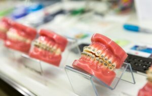 Ortodoncja – skuteczne metody prostowania zębów